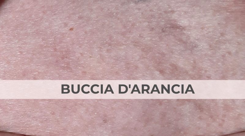 Medicina-Estetica-dott-Letizia_Foglieni_cellulite_buccia-arancia-the-minutes-fly